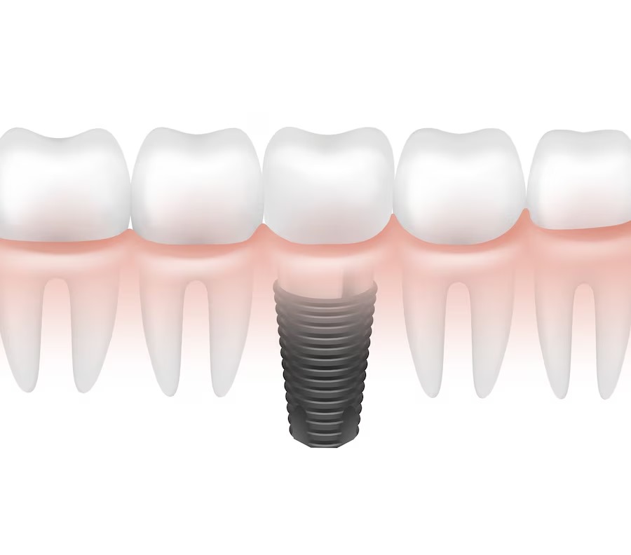 Dental Implants